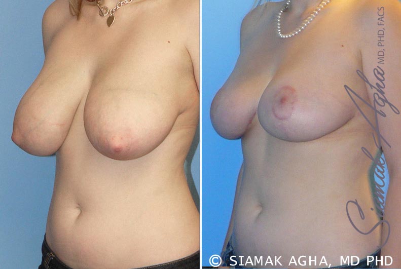 Breast Reduction Patient 2
