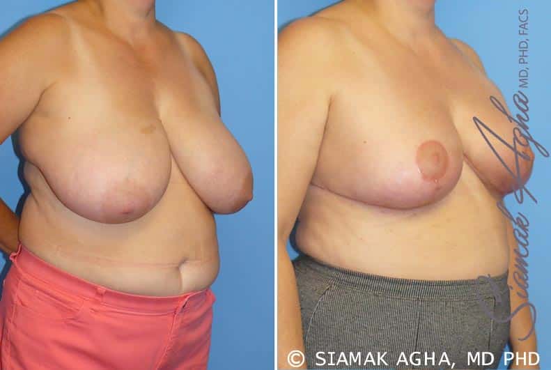 Orange County Breast Reduction Patient 3 Front Right Newport Beach, CA