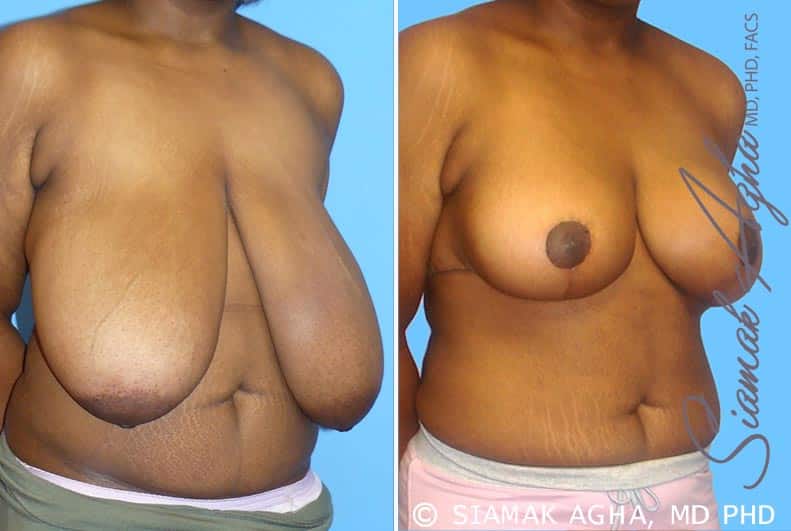 Orange County Breast Reduction Patient 4 Front Right Newport Beach, CA
