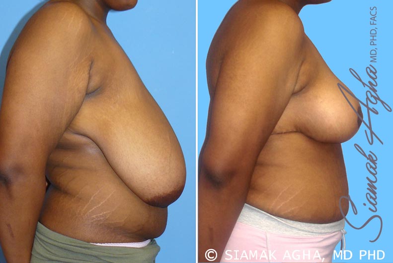 Breast Reduction Patient 4