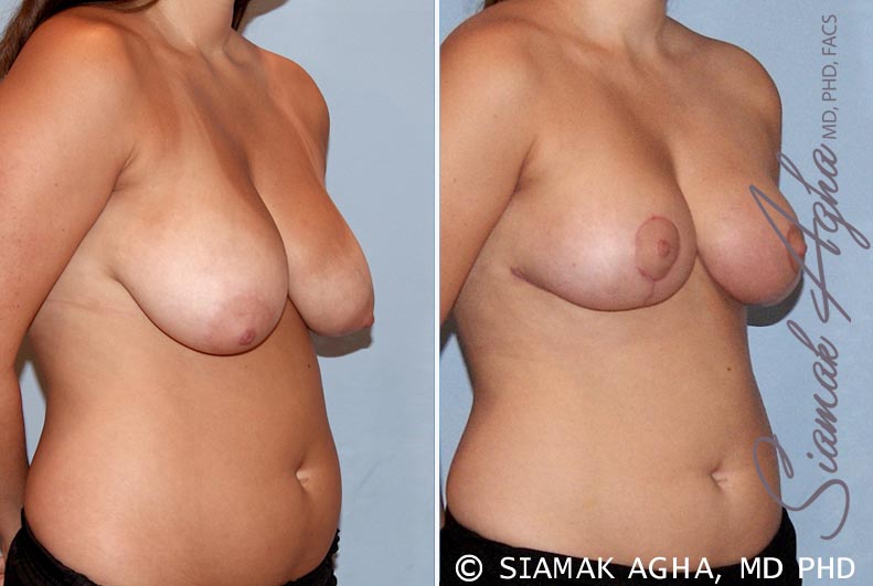 Orange County Breast Reduction Patient 7 Front Right Newport Beach, CA