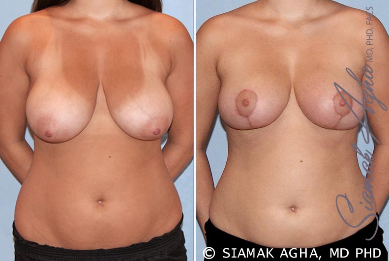 Breast Reduction Patient 7