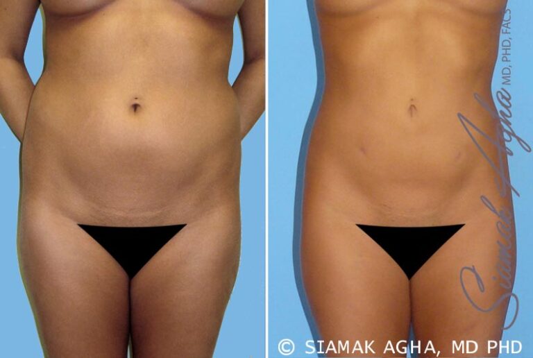 orange-county-liposuction-patient-2-front