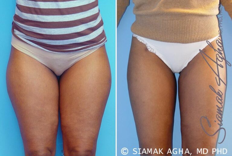 orange-county-liposuction-patient-3-front