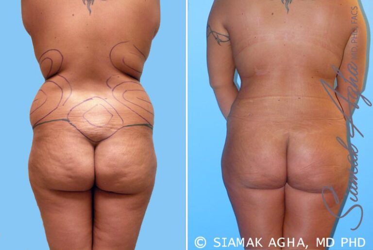 orange-county-liposuction-patient-4-back