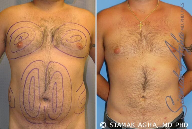 orange-county-liposuction-patient-6-front