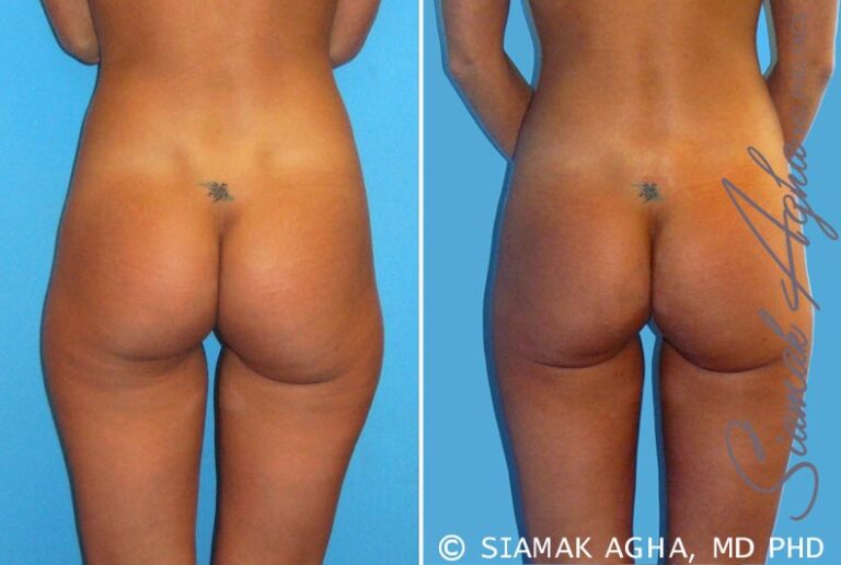 orange-county-liposuction-patient-7-back