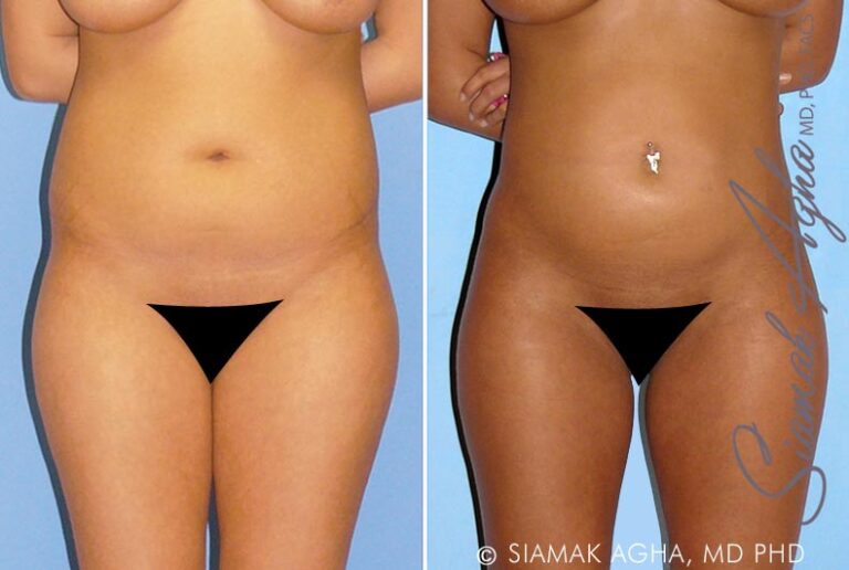 orange-county-liposuction-patient-8-front