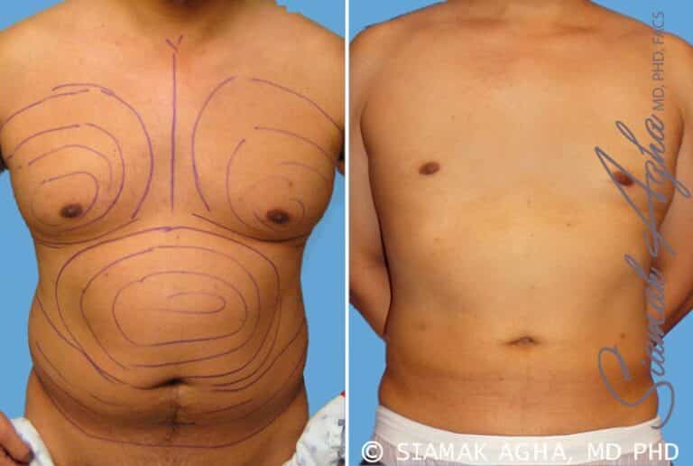 orange-county-liposuction-patient-9-front