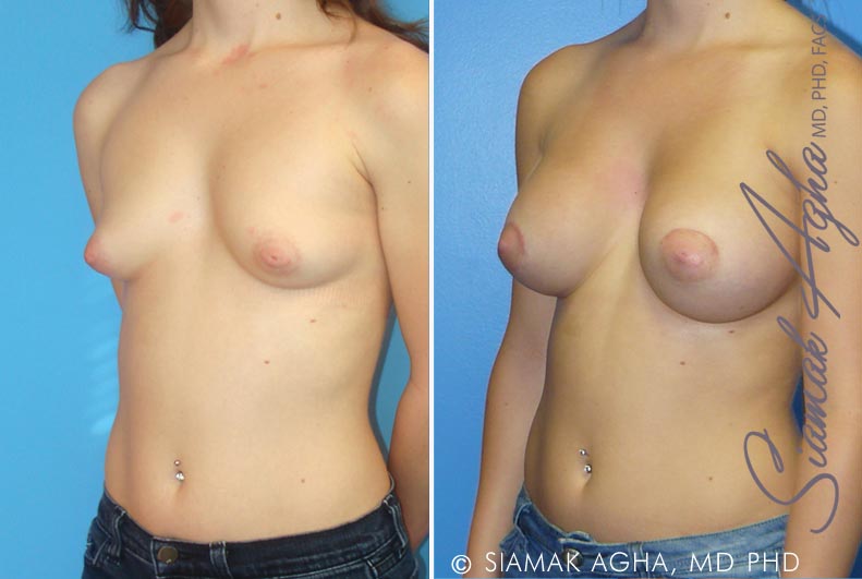 orange county tubular breast correction patient 1 front left Newport Beach, CA