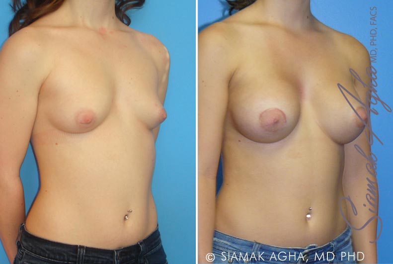 orange county tubular breast correction patient 1 front right Newport Beach, CA