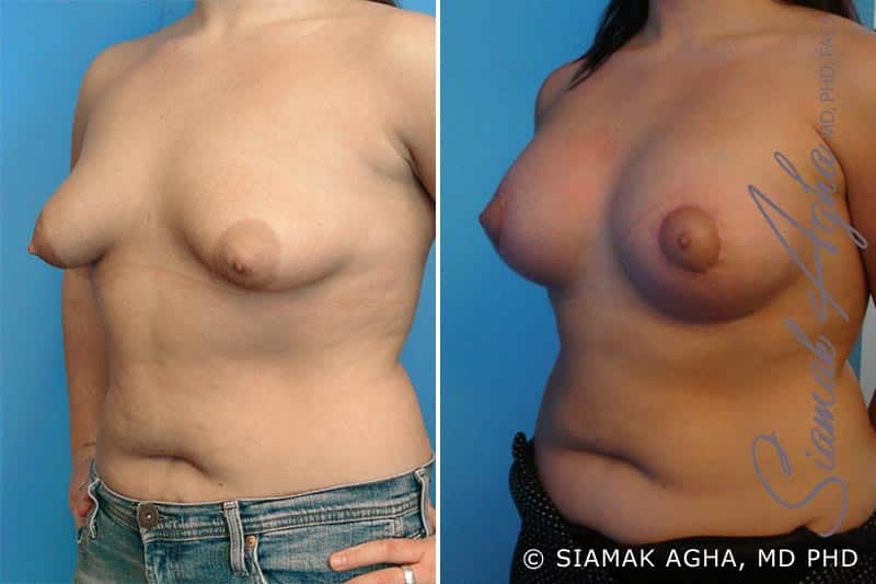 Tubular Breast Correction Patient 2