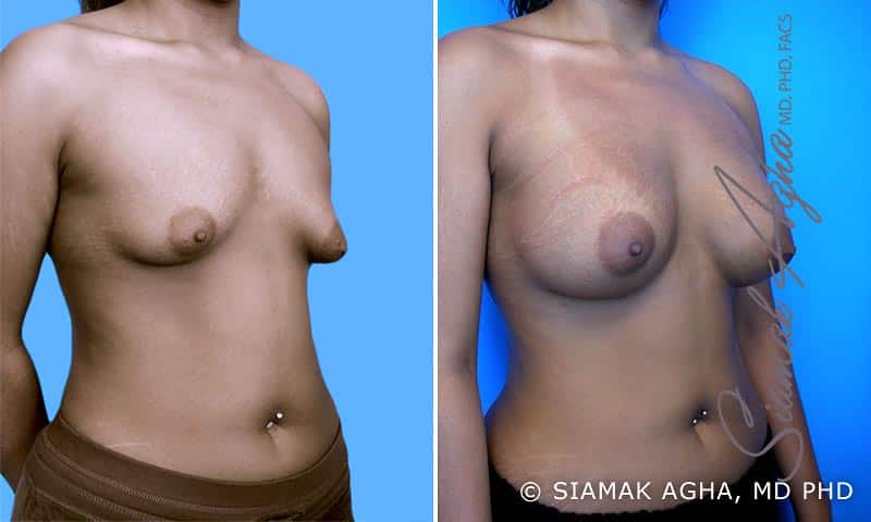 Tubular Breast Correction Patient 3