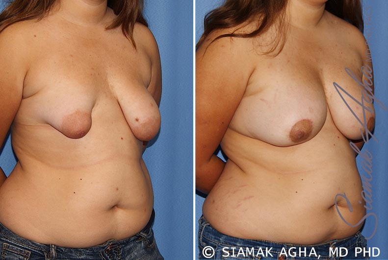 Tubular Breast Correction Patient 4