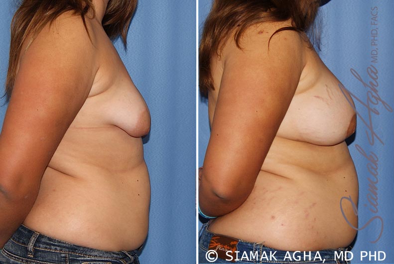 Tubular Breast Correction Patient 4