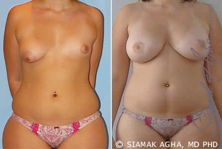 Tuberous Breast Surgery Newport Beach￼