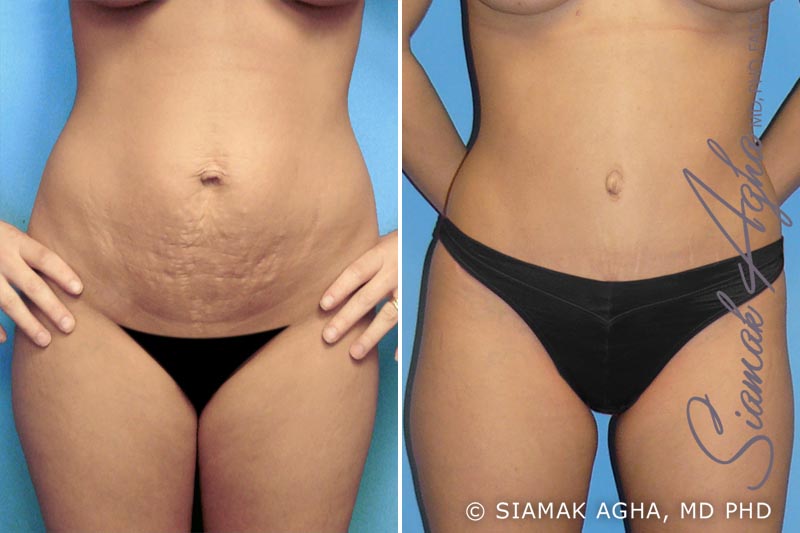 Body Procedures Before and After Photo Gallery