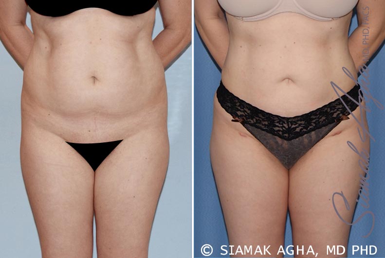 Real photos Brazilian butt lifting, Angelina, before and after surgery - Dr  Osadowska Clinic Poland