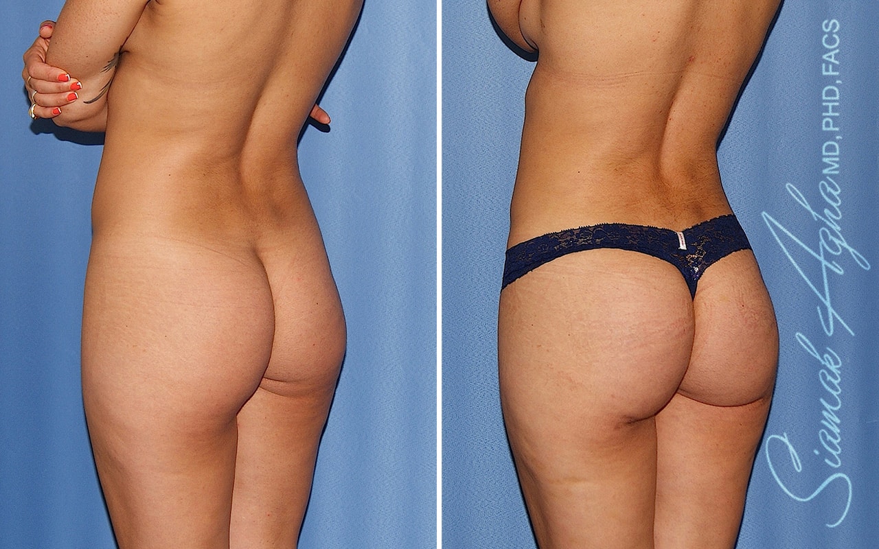 Brazilian Butt Lift Patient 63