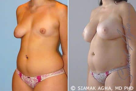 Breast Fat Transfer Patient 1
