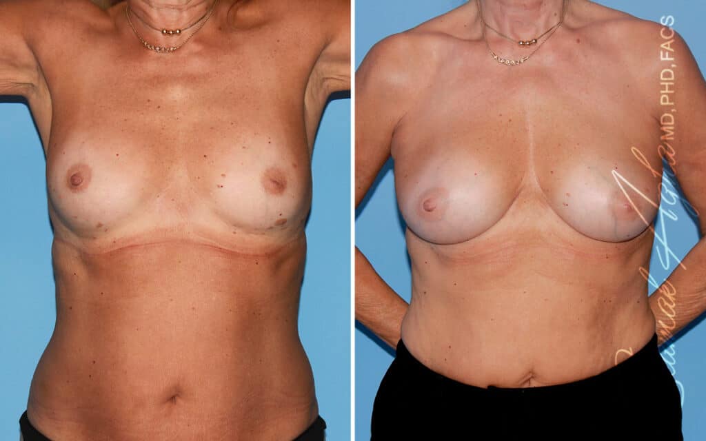 Breast Fat Transfer Newport Beach￼