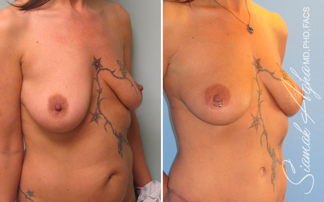 Breast Fat Transfer Patient 4