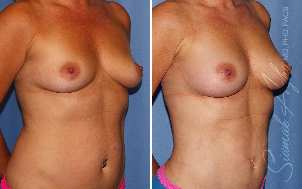 Breast Fat Transfer Patient 5