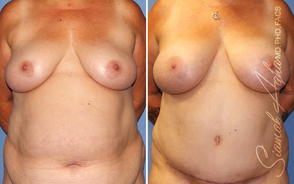 Breast Implants vs. Breast Fat Transfer