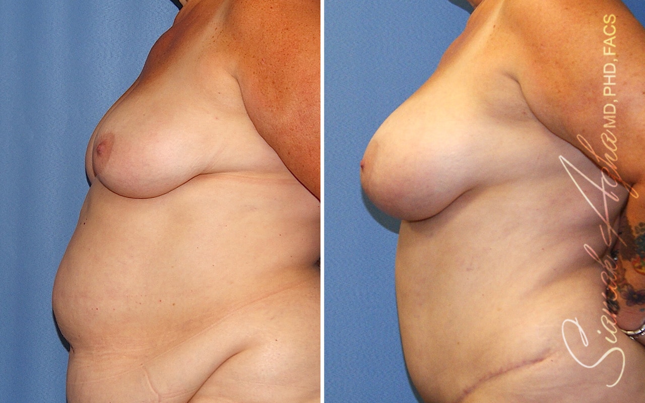 Breast Fat Transfer Patient 8