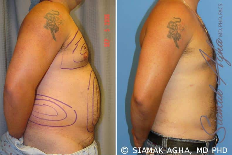 Male Breast Reduction Patient 1