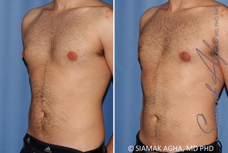 Orange County Male Breast Reduction Patient 10 Front Left Newport Beach, CA