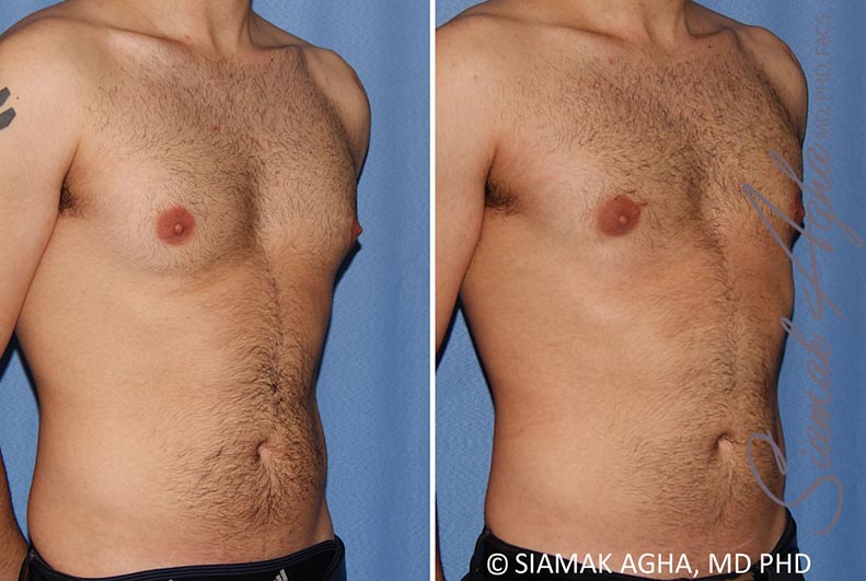 Orange County Male Breast Reduction Patient 10 Front Right Newport Beach, CA