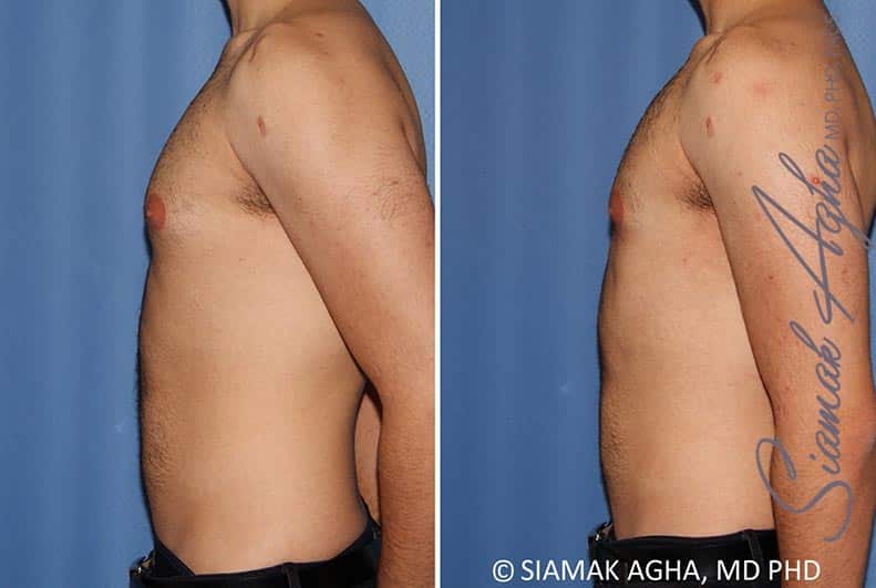 Male Breast Reduction Patient 10