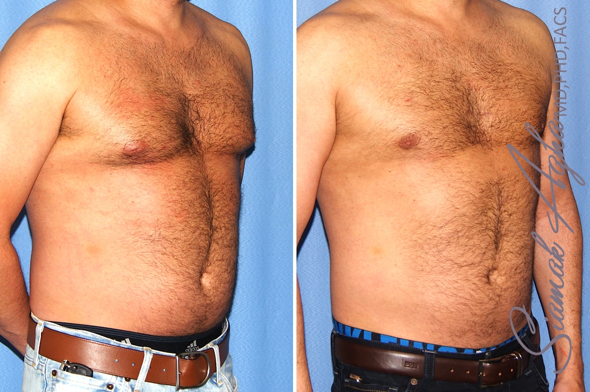 Male Breast Reduction Patient 11