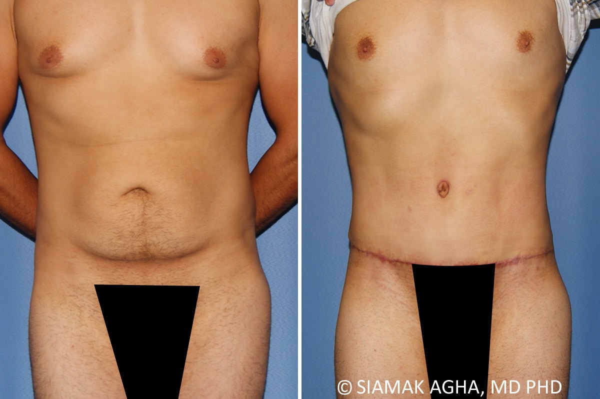 Male Breast Reduction Patient 12