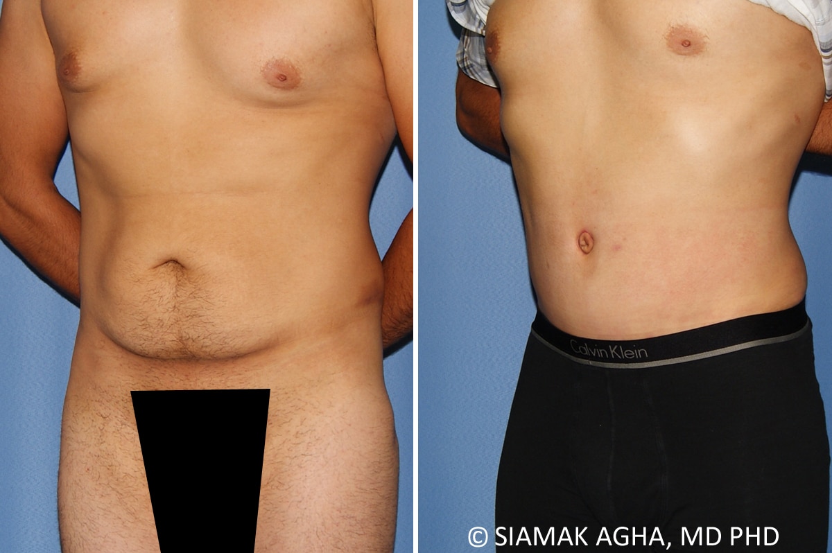 Male Breast Reduction Patient 12