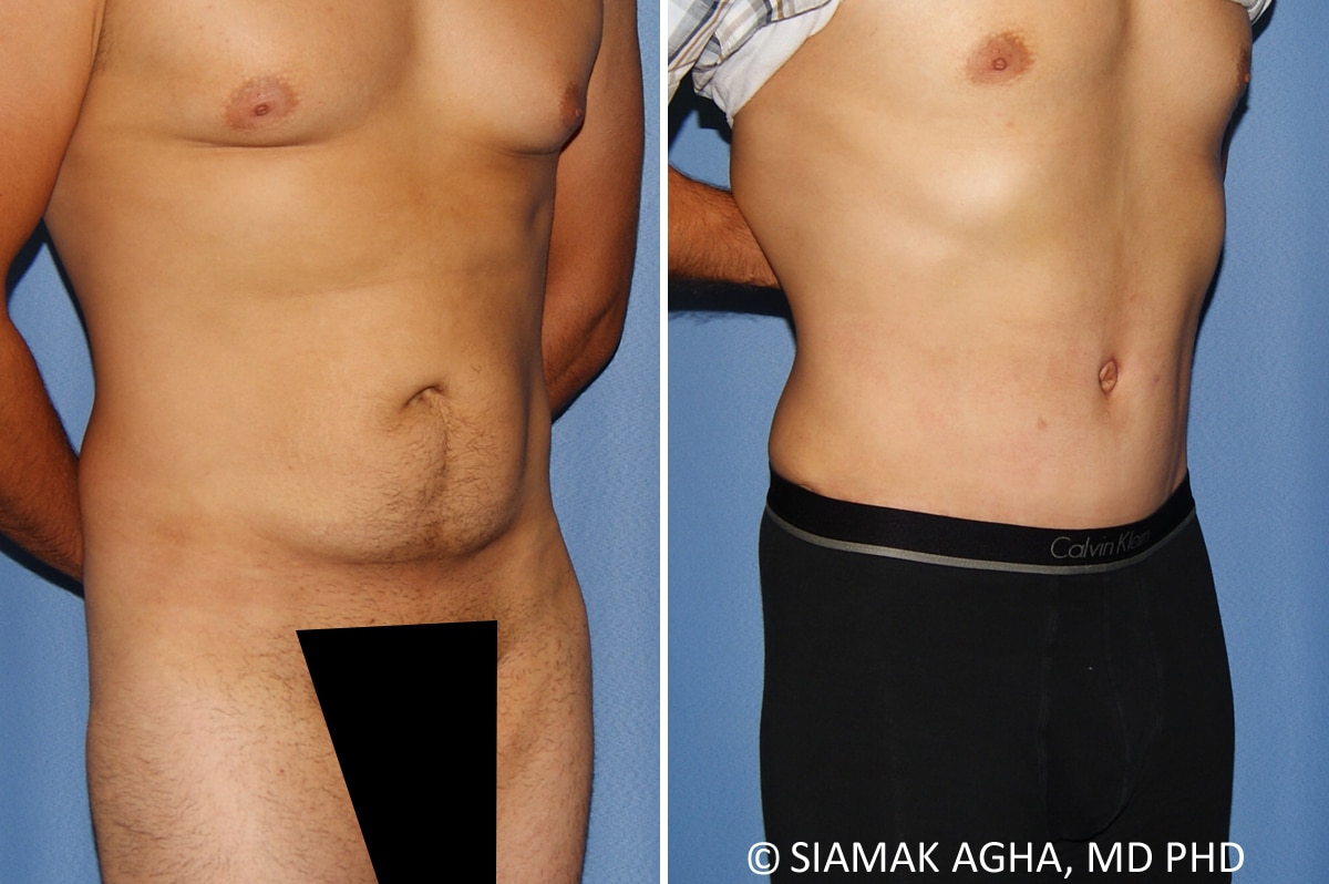 Orange County Male Breast Reduction Patient 12 Front Right Newport Beach, CA