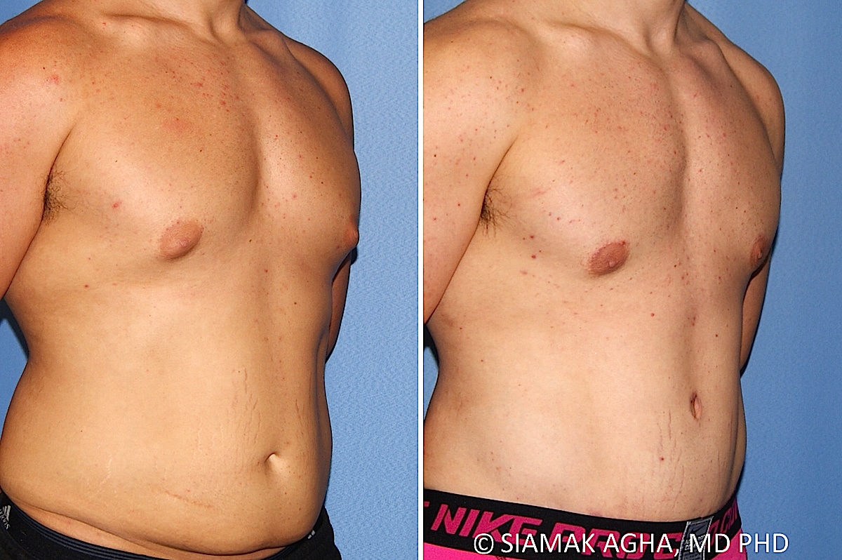 Orange County Male Breast Reduction Patient 13 Front Right Newport Beach, CA