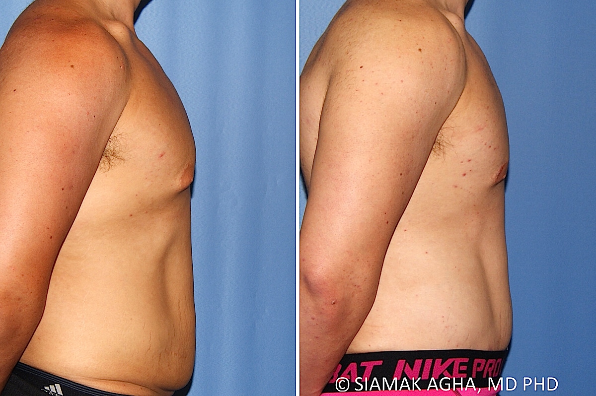 Male Breast Reduction Patient 13