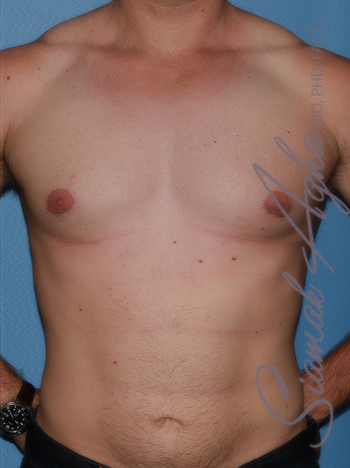 Puffy Nipples and Gynecomastia - Orange County, Newport Beach - Male Breast  Reduction