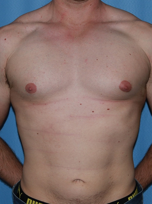 Chest Masculinization Before & Afters