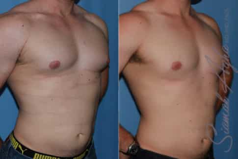 Orange County Male Breast Reduction Patient 14 Front Right Newport Beach, CA