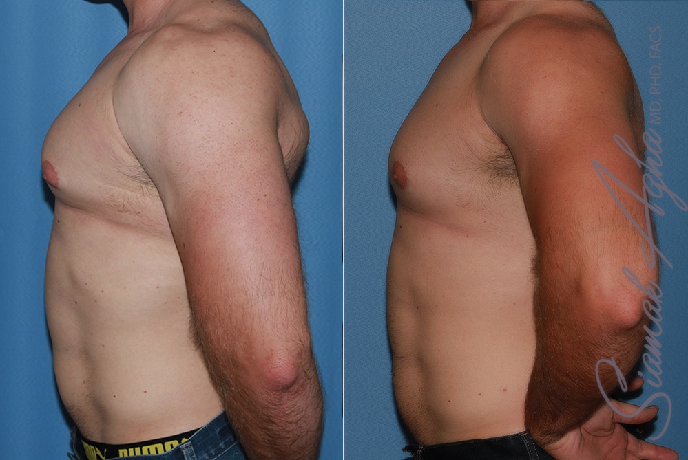 Male Breast Reduction Patient 14