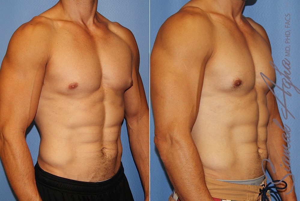 Orange County Male Breast Reduction Patient 15 Front Right Newport Beach, CA