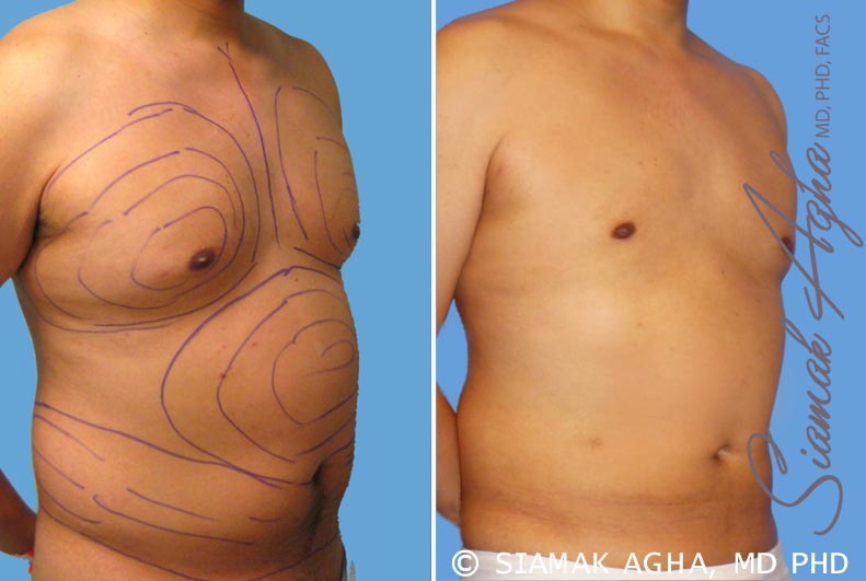 orange county male breast reduction patient 3 front right Newport Beach, CA