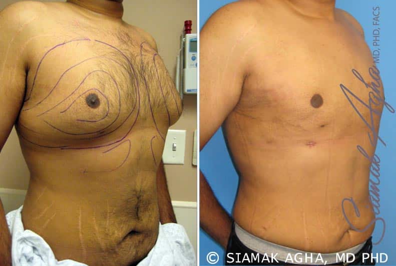 orange county male breast reduction patient 4 front right Newport Beach, CA