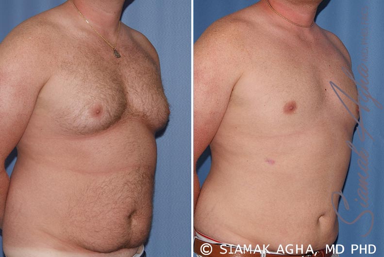 orange county male breast reduction patient 5 front right Newport Beach, CA