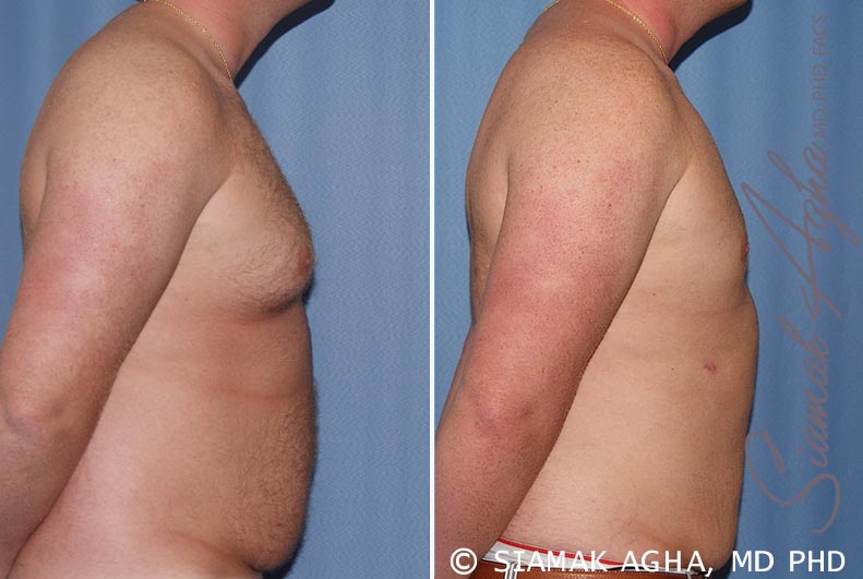 Male Breast Reduction Patient 5