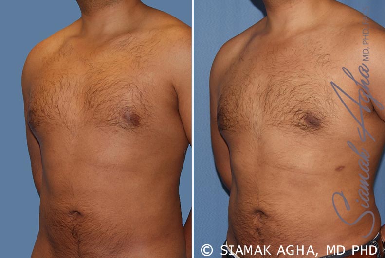 Male Breast Reduction Patient 6
