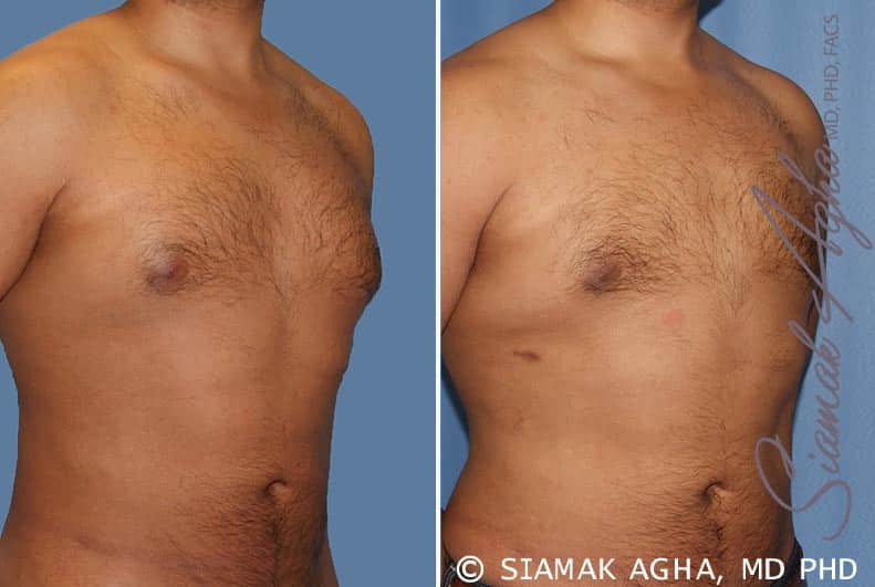 Orange County Male Breast Reduction Patient 6 Front Right Newport Beach, CA